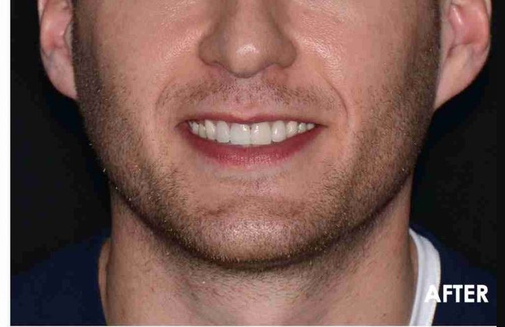 After: even, natural-white smile