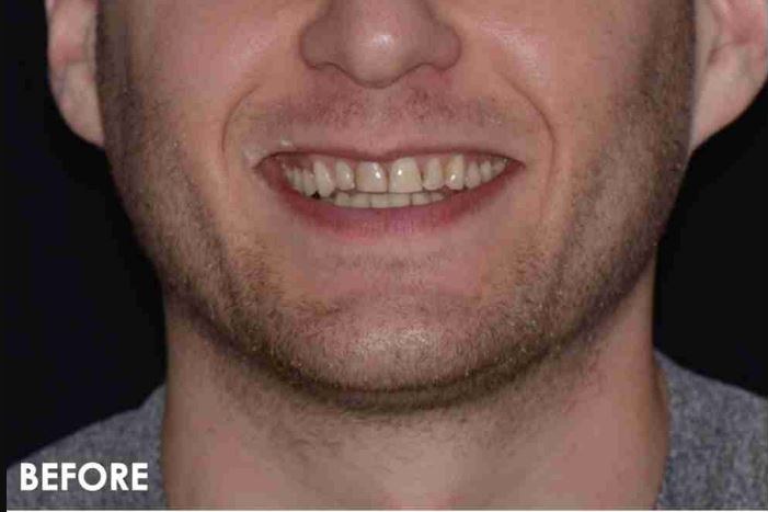 Before: worn, uneven teeth
