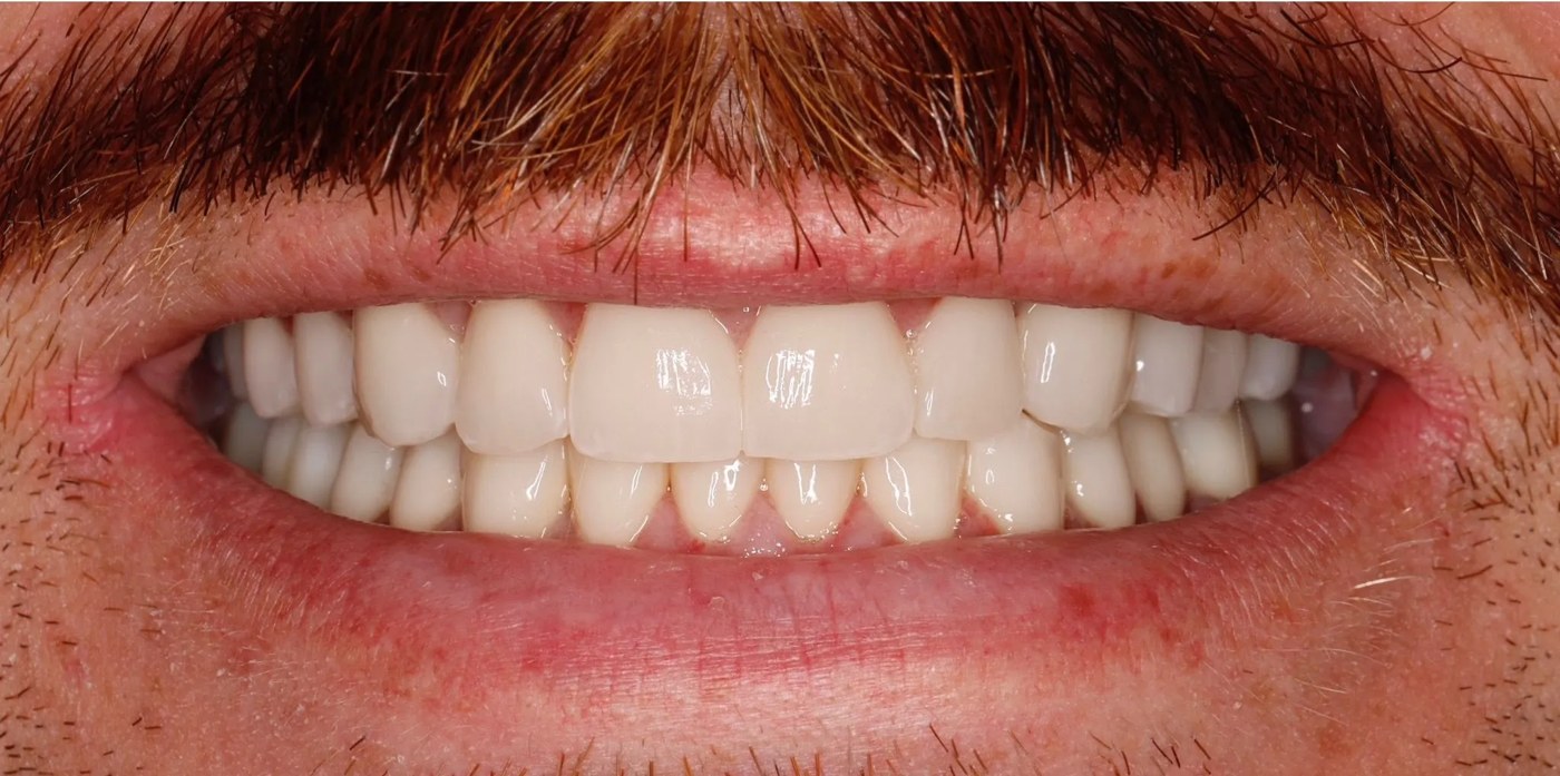 Case 05 after treatment